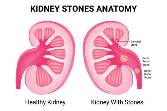 Download Kidney Stones Anatomy Science Design - Stones Collection